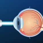 Can Cataracts Be Treated Without Surgery