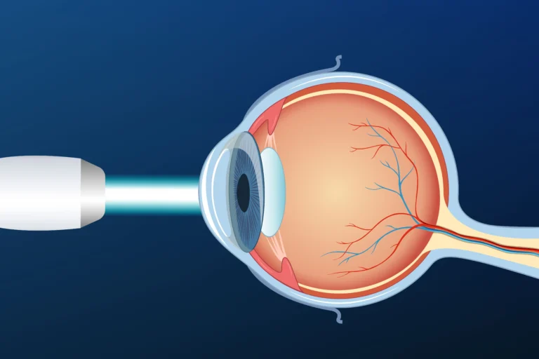 Can Cataracts Be Treated Without Surgery