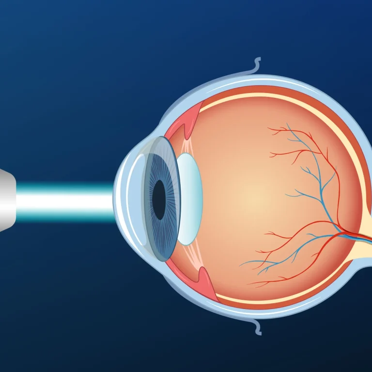 Can Cataracts Be Treated Without Surgery